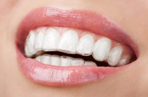 Comprehensive Dental Implant Services in Manchester