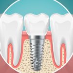 Benefits of Choosing Dental Implants in Melbourne