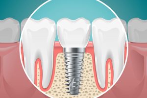 Benefits of Choosing Dental Implants in Melbourne