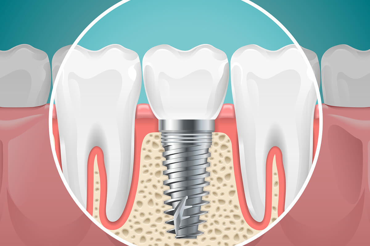 Benefits of Choosing Dental Implants in Melbourne