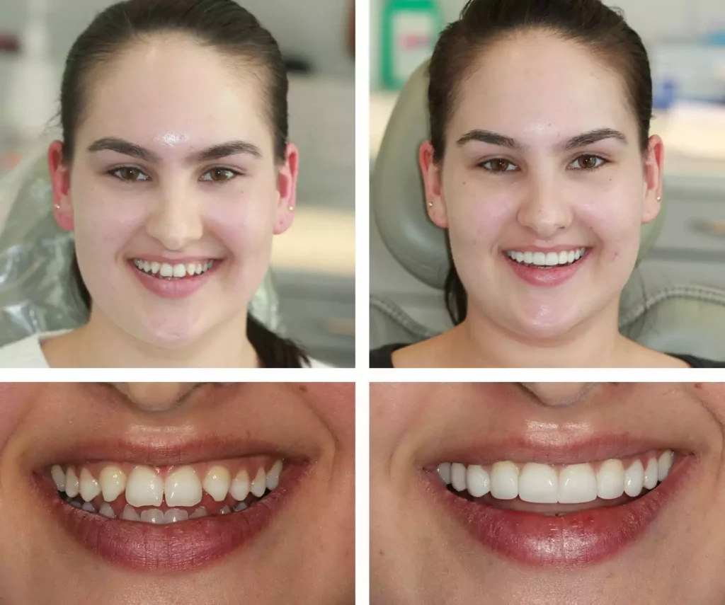 How Composite Bonding Transforms Smiles for Patients with Dental Anxiety Through Minimally Invasive Treatment