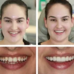 How Composite Bonding Transforms Smiles for Patients with Dental Anxiety Through Minimally Invasive Treatment